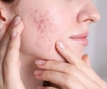Pulsed dye laser therapy not effective in treating acne