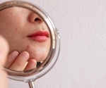 Individuals with acne face stigmatizing attitudes from the general public, study finds