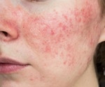 Acne may be a natural, transient inflammatory state when facial skin is exposed to microbes