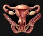 UCSF research maps over 600 conditions linked to endometriosis