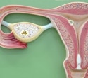 New menstrual blood test detects endometriosis with five times greater sensitivity